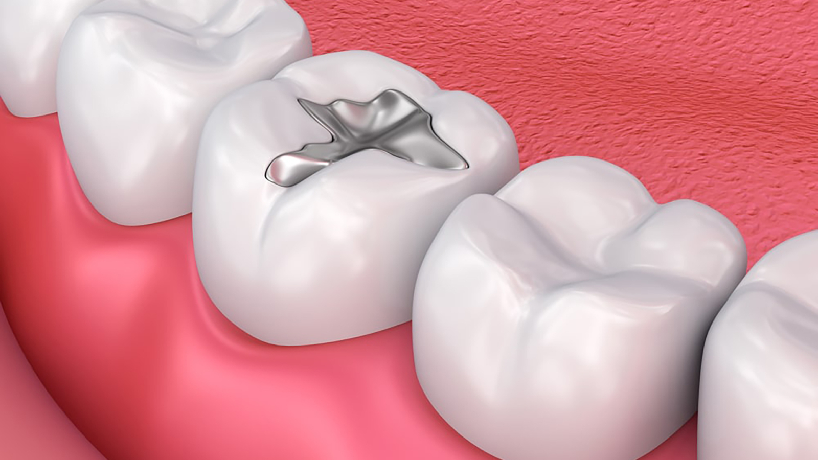 CASUARINA DENTAL FOLLOWS IAOMT/SMART MERCURY AMALGAM REMOVAL