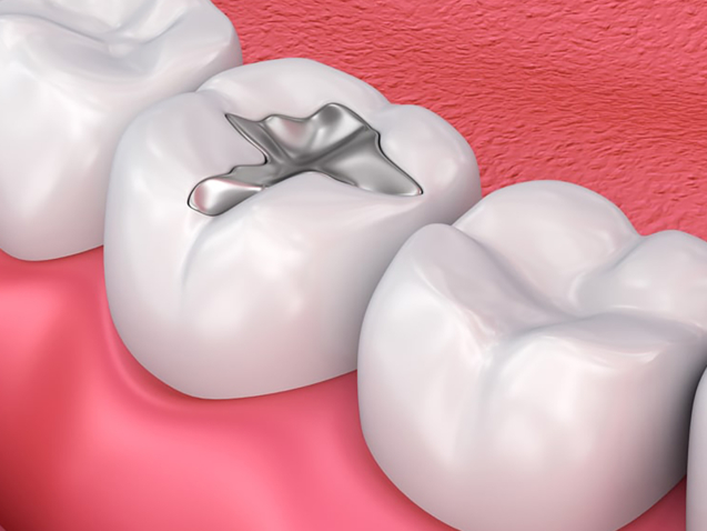 CASUARINA DENTAL FOLLOWS IAOMT/SMART MERCURY AMALGAM REMOVAL